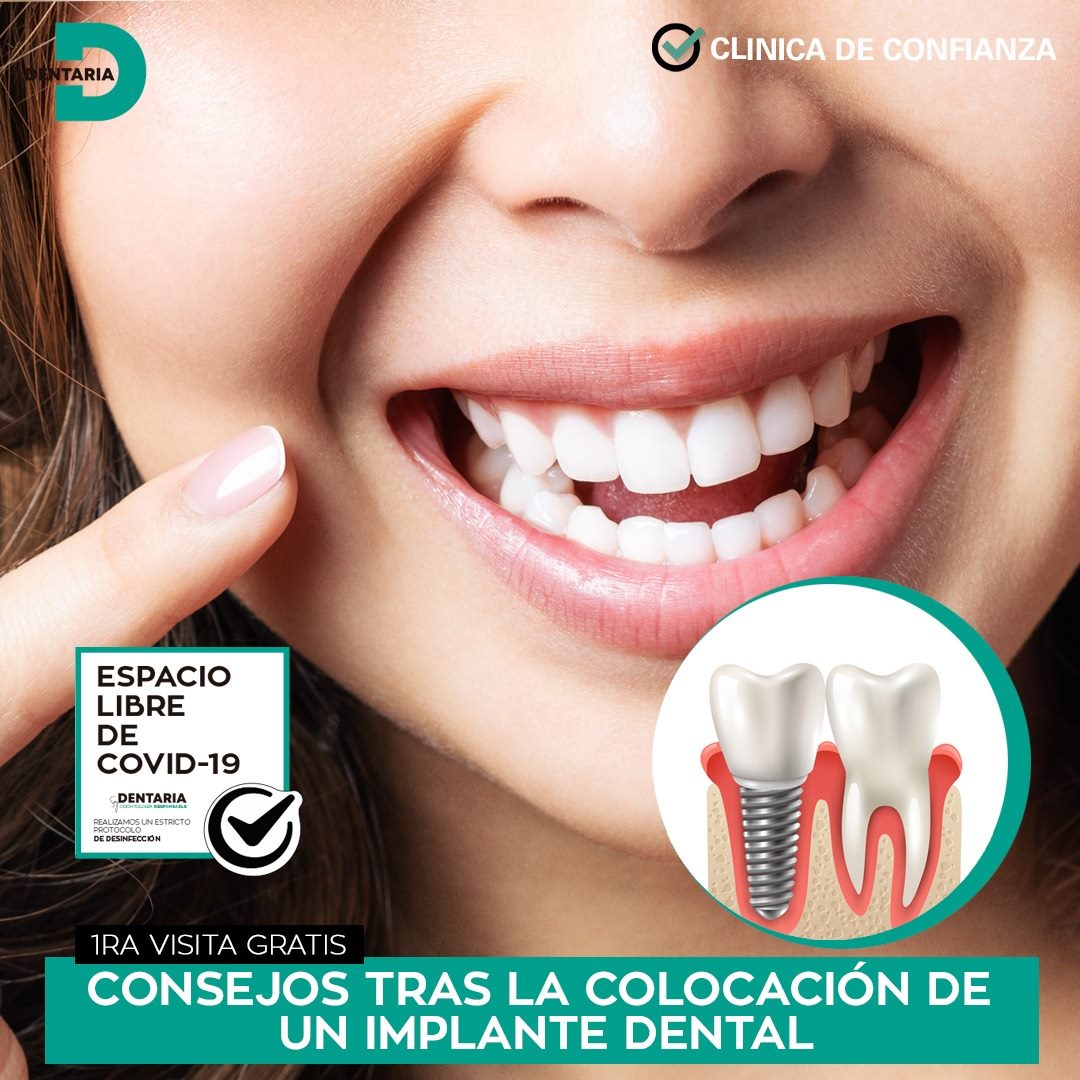 efecto pronóstico Exención Consejos tras colocación implante dental | Soy Dentaria