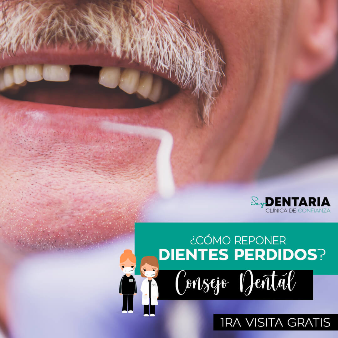 ¿Cómo reponer dientes perdidos?